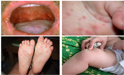 Tăng cường phòng, chống bệnh tay chân miệng và các bệnh truyền nhiễm khác.